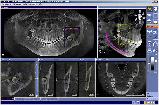 3D CBCT cone beam scan showing full jaw model with teeth, nerves, bone and sinuses — in-office at Frisco Dental Hub Frisco TX 75035