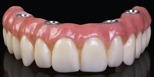 All-on-4 hybrid dental implant prosthesis at Frisco Dental Hub — full arch of porcelain teeth with titanium implant abutment connectors, permanent fixed arch replacement on 4 implants by UCSF-trained Dr. Nannapaneni DDS in Frisco TX 75035 serving Frisco, Plano, McKinney, Allen, Prosper, Celina, Little Elm, The Colony, Aubrey, Melissa and Anna TX
