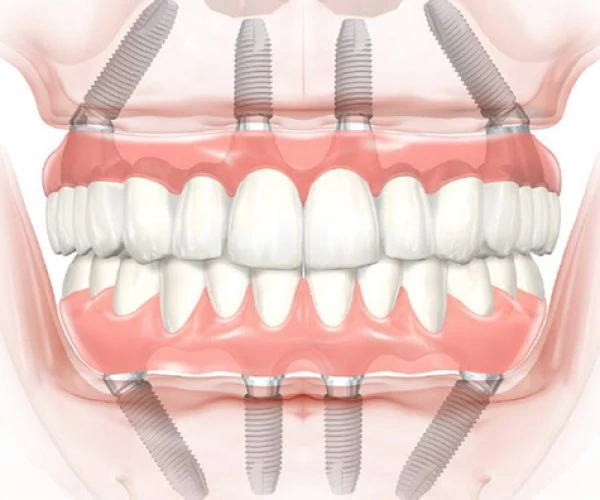 All-on-4 dental implant angulation diagram at Frisco Dental Hub — 3D illustration showing 4 titanium implant posts with angled posterior implants at 30-45 degrees supporting a full arch fixed prosthesis of 12-14 porcelain teeth — by UCSF-trained Dr. Nannapaneni DDS in Frisco TX 75035