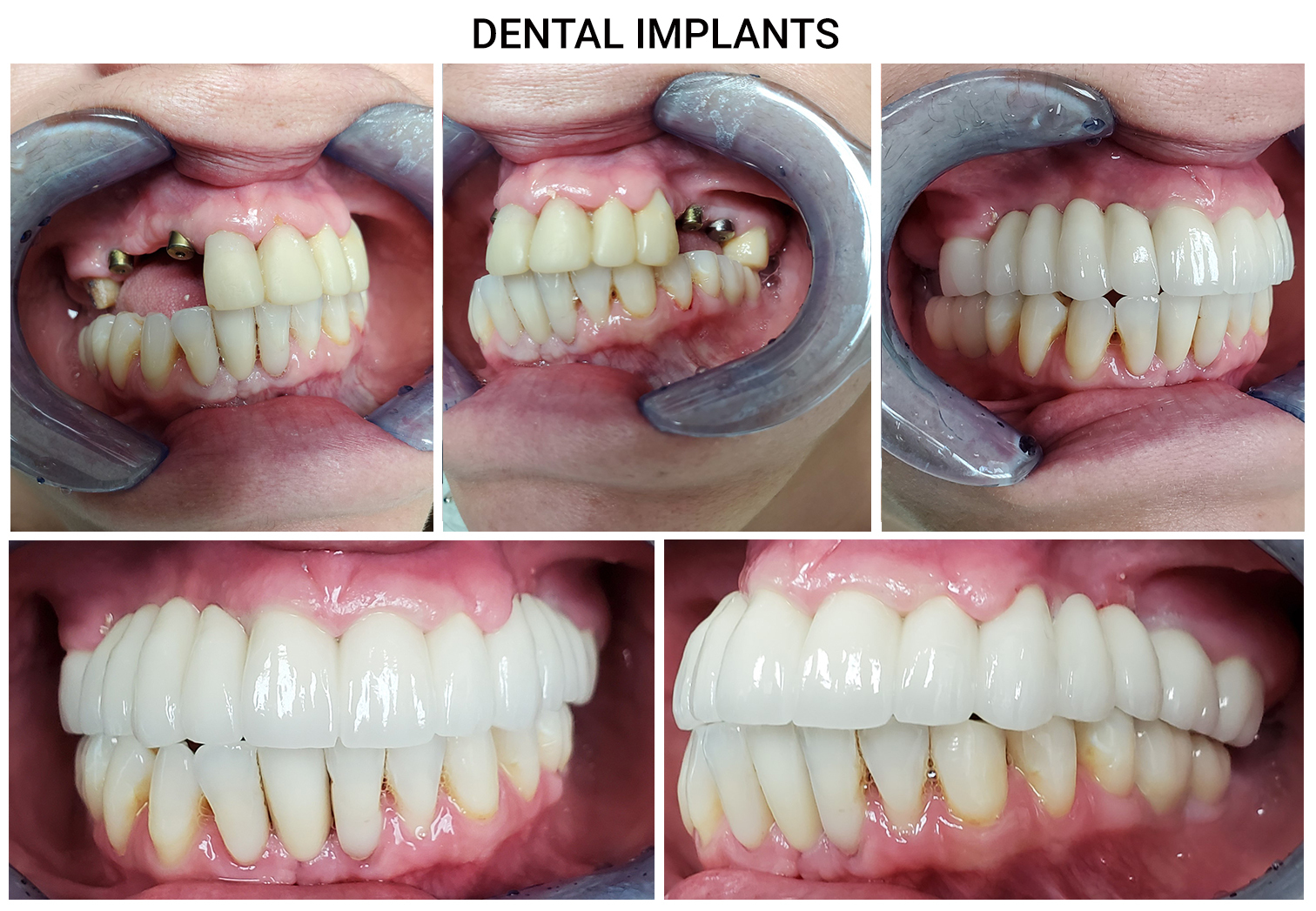 Implant-supported bridge 3D illustration at Frisco Dental Hub — two titanium implant posts placed in jawbone supporting a 3-unit porcelain bridge to replace 2-4 consecutive missing teeth permanently, no grinding of adjacent teeth required — by UCSF-trained Dr. Nannapaneni DDS in Frisco TX 75035 serving Frisco, Plano, McKinney, Allen, Prosper TX
