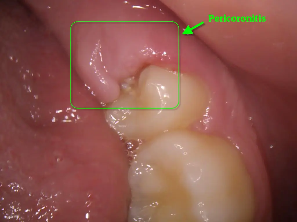 Pericoronitis — gum infection around partially erupted wisdom tooth at Frisco Dental Hub Frisco TX
