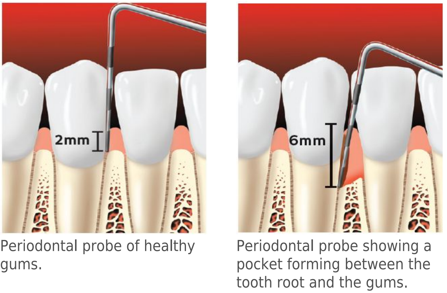 Periodontal probe comparison — 2mm healthy gum pocket (left) vs 6mm diseased pocket with gum recession (right). Dr. Nannapaneni uses periodontal probing at every comprehensive exam at Frisco Dental Hub, Frisco TX 75035