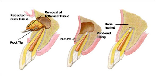 Apicoectomy anatomy diagram showing retracted gum tissue, removal of inflamed root tip, root-end filling placement, and bone healing in Frisco TX