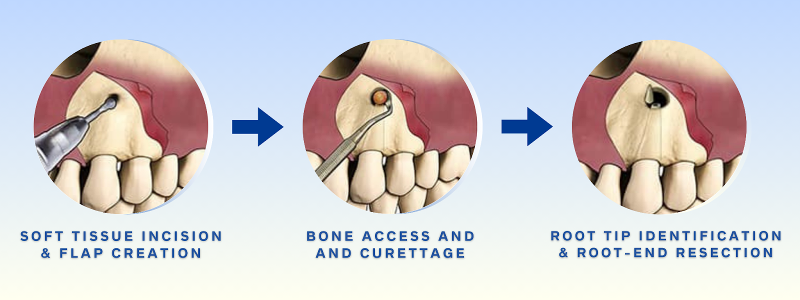 Apicoectomy surgical procedure steps — soft tissue incision, bone access, and root-end resection diagram at Frisco Dental Hub Frisco TX