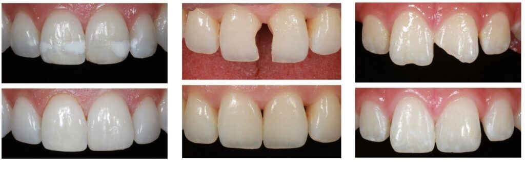 BPA-free composite white tooth-colored fillings — mercury-free restorations at Frisco Dental Hub Frisco TX