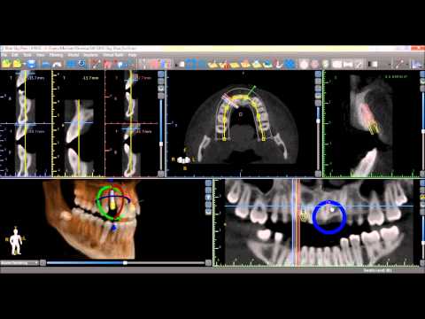 Computer-guided dental implant planning software at Frisco Dental Hub — 3D CBCT cone beam scan showing precise implant positioning with cross-sectional views, panoramic X-ray, and digital measurement guides used by UCSF-trained Dr. Nannapaneni DDS in Frisco TX 75035 for single dental implant placement — serving Frisco, Plano, McKinney, Allen, Prosper TX