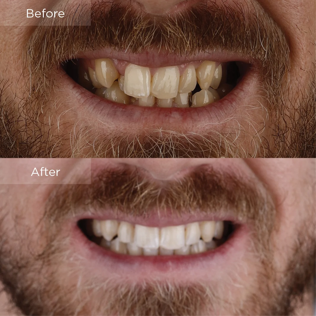 Crowded teeth before and after clear aligner treatment at Frisco Dental Hub Frisco TX — adult patient upper and lower crowding corrected in 14 months. Photographed with written patient consent.