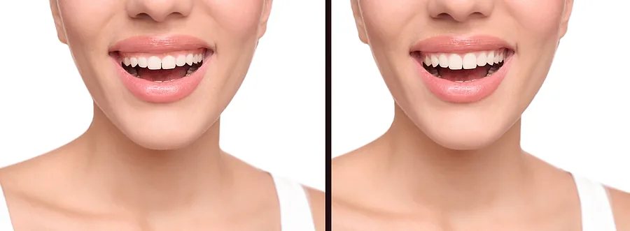 Crown lengthening before and after photo at Frisco Dental Hub Frisco TX — patient's smile before shows excess gum tissue covering the natural tooth length; after photo shows balanced gumline and full tooth proportions revealed by Dr. C's crown lengthening procedure