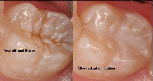 Dental sealant being applied to a child's molar tooth at Frisco Dental Hub — protective coating seals deep grooves to prevent cavities and tooth decay in Frisco TX 75035