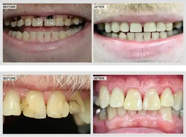 Real before and after dental bonding cases at Frisco Dental Hub — chipped, gapped and stained teeth restored with same-day composite resin bonding by Dr. C, Frisco TX