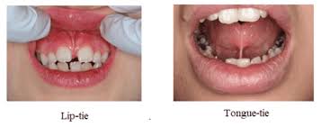 Clinical reference — buccal and lingual frenum anatomy
