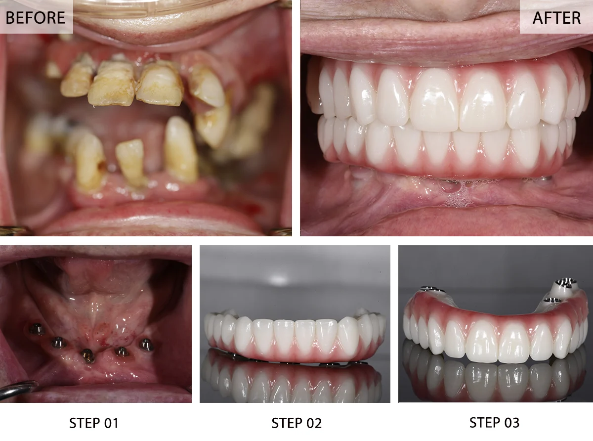 All-on-4 dental implant before and after case at Frisco Dental Hub — patient with severely failing teeth (before), panoramic X-ray showing 4 implant posts placed in jaw, All-on-4 prosthesis fabricated, and final beautiful smile result (after) — full arch permanent teeth by UCSF-trained Dr. Nannapaneni DDS in Frisco TX 75035 serving Frisco, Plano, McKinney, Allen, Prosper TX