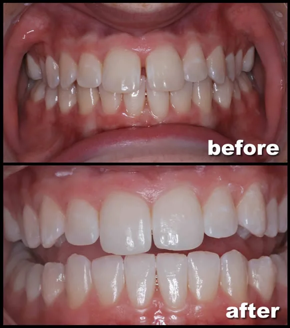 Gap closure diastema before and after clear aligners at Frisco Dental Hub Frisco TX — classic central-incisor gap closed in 10 months, no surgery no veneers. Real patient photo.