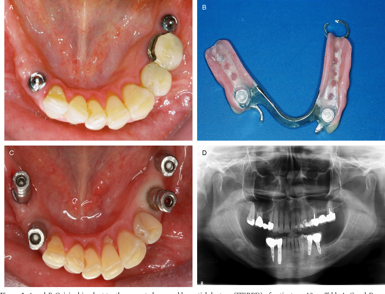Implant-supported partial denture at Frisco Dental Hub — titanium implant posts with snap attachments stabilizing a removable partial denture for multiple scattered missing teeth in Frisco TX 75035, by UCSF-trained Dr. Nannapaneni DDS serving Frisco, Plano, McKinney, Allen, Prosper, Celina TX