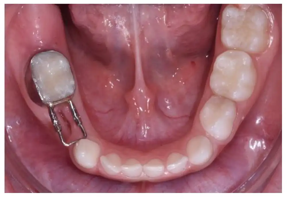 Lingual arch space maintainer in a child's mouth — custom pediatric dental spacer connecting both lower second molars to preserve arch length after early baby tooth loss, placed by Dr. C at Frisco Dental Hub, Frisco TX 75035. Bilateral fixed appliance prevents tooth drifting and crowding before permanent teeth erupt.