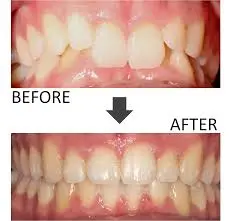 Clear aligner overbite correction before and after at Frisco Dental Hub — Invisalign Bite Ramp technology correcting deep overbite in Frisco TX patient