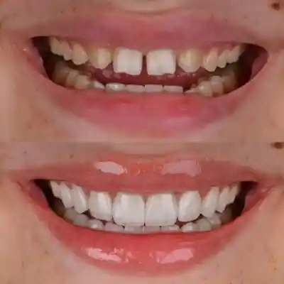 Real porcelain veneers result at Frisco Dental Hub — before and after of front teeth restored with custom porcelain veneers by Dr. C, Frisco TX