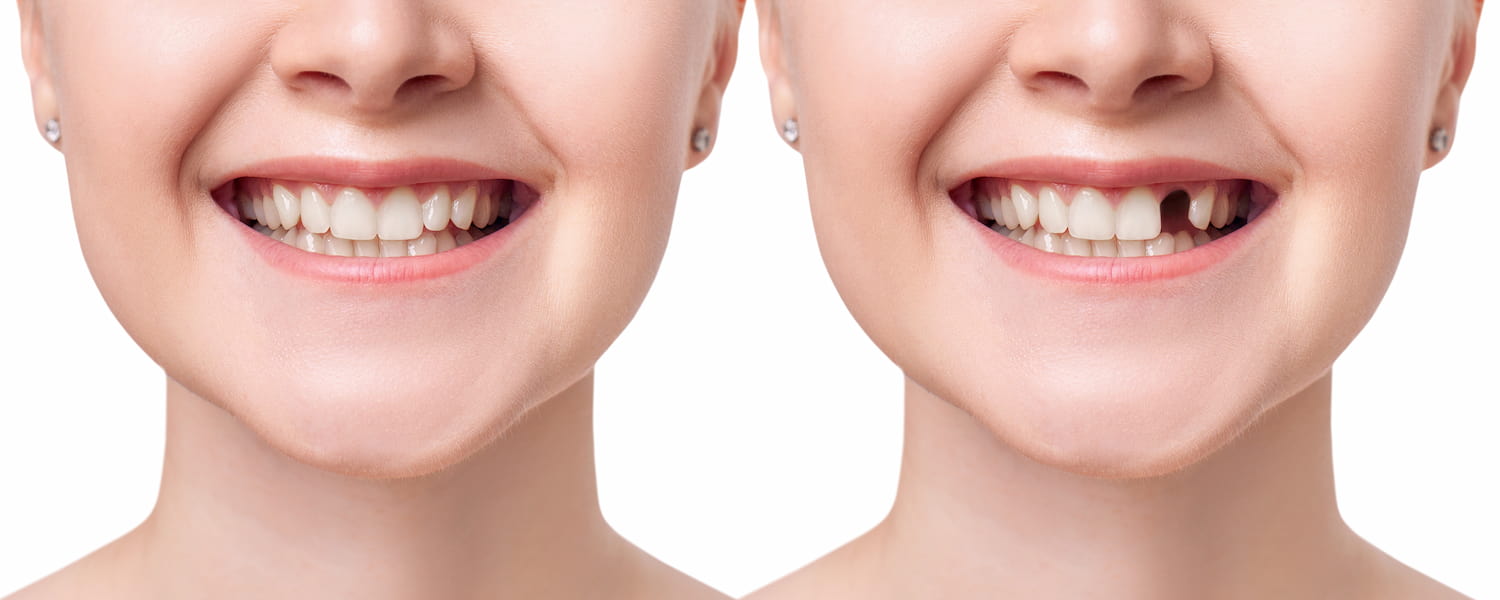 Before and after single dental implant at Frisco Dental Hub — patient with one missing tooth (before) next to a complete natural-looking smile restored with a single implant crown (after) — permanent tooth replacement by UCSF-trained Dr. Nannapaneni DDS in Frisco TX 75035 serving Frisco, Plano, McKinney, Allen, Prosper TX