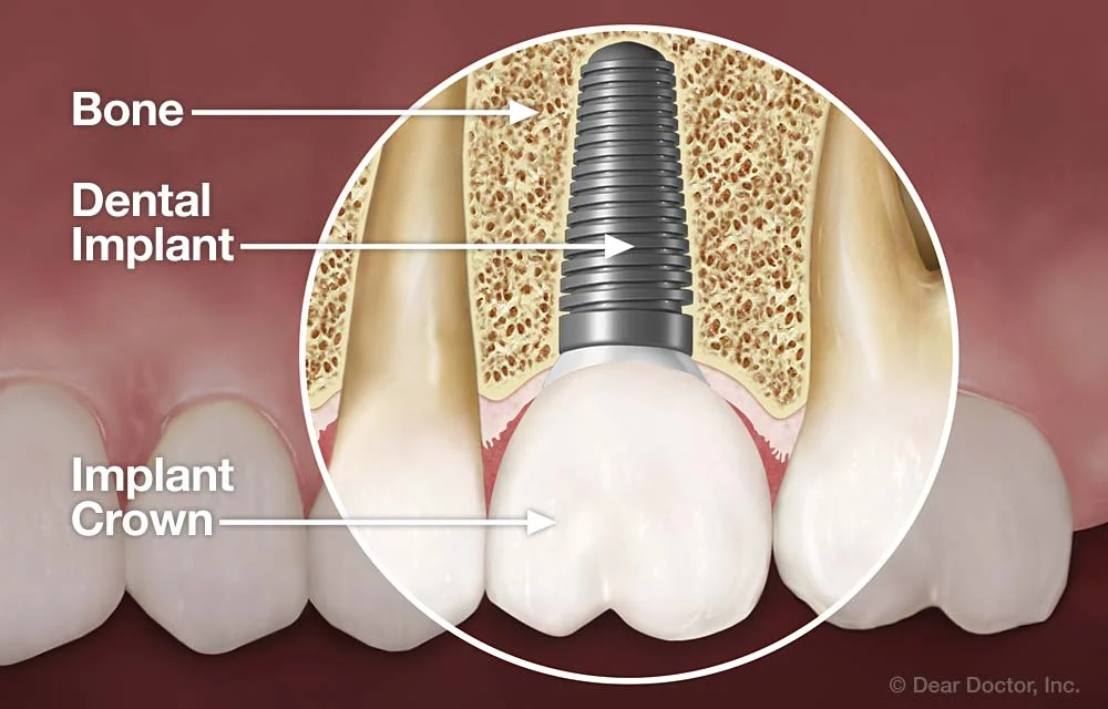 Single dental implant anatomy diagram showing 3 components: titanium implant post fused to jawbone, abutment connector, and porcelain crown — used by Dr. Chakrapani Nannapaneni DDS at Frisco Dental Hub, 4500 Hillcrest Rd Suite 190 Frisco TX 75035, to permanently replace a missing tooth in Frisco TX serving Plano McKinney Prosper and all North Texas