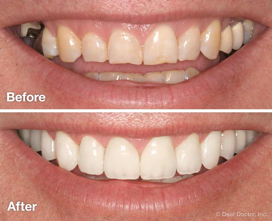 Before and after cosmetic smile makeover at Frisco Dental Hub — worn, uneven front teeth transformed into a bright, symmetrical smile by UCSF-trained Dr. C in Frisco TX