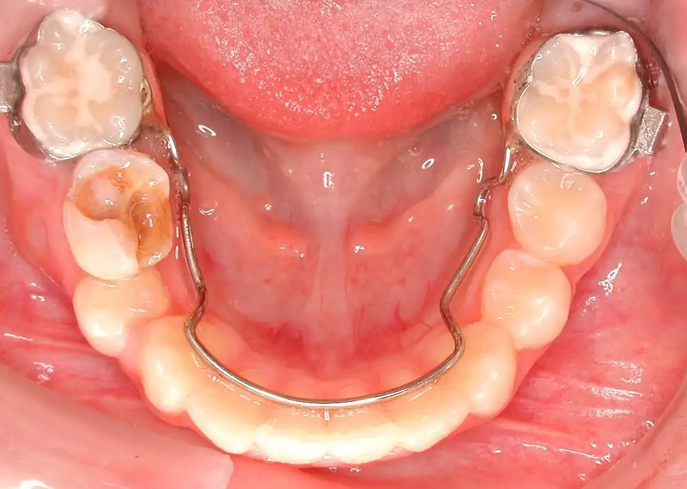 Band-and-loop space maintainer placed on a child's lower molar at Frisco Dental Hub — clinical photo of a custom pediatric dental spacer preserving the space for the permanent premolar to erupt, Frisco TX