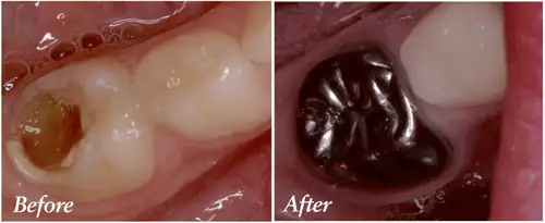 Pediatric pulpotomy result — clinical photo of a baby molar with deep decay (left) and the same tooth restored with a stainless steel crown after pulpotomy (right) at Frisco Dental Hub, Frisco TX