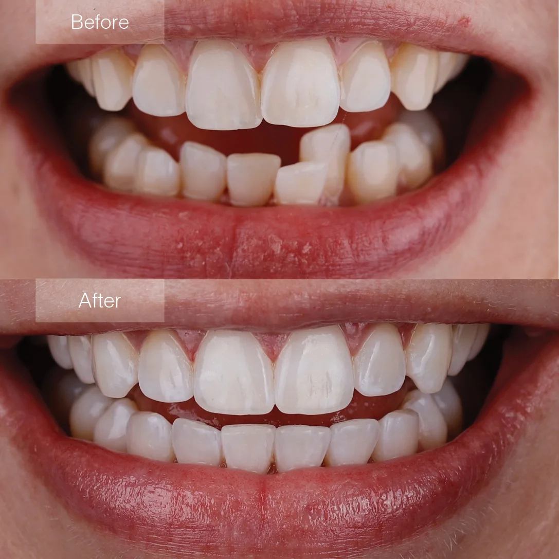 Teen clear aligner before and after at Frisco Dental Hub Frisco TX — crowded and misaligned teeth corrected with clear aligners, real patient result. Serving Plano, McKinney & Prosper TX.