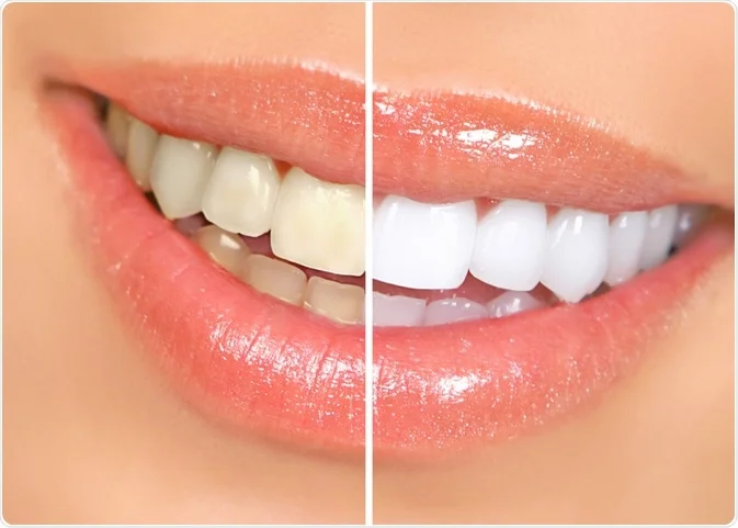 Clear aligner treatment completion and free professional whitening result at Frisco Dental Hub — straight and bright smile after Invisalign in Frisco TX