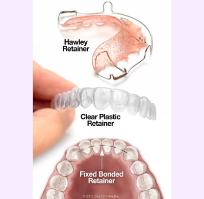 Three types of retainers at Frisco Dental Hub: Essix clear retainer, Hawley wire retainer, and permanent bonded retainer — Frisco TX 75035